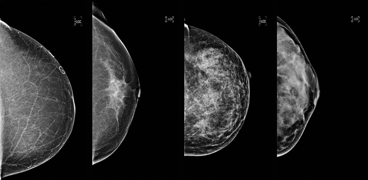 3d mammogram technology means earlier breast cancer detection fewer